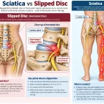 Diagram comparing Sciatica vs Slipped Disc, showing a herniated lumbar disc pressing on a nerve root and pain travelling down one leg
